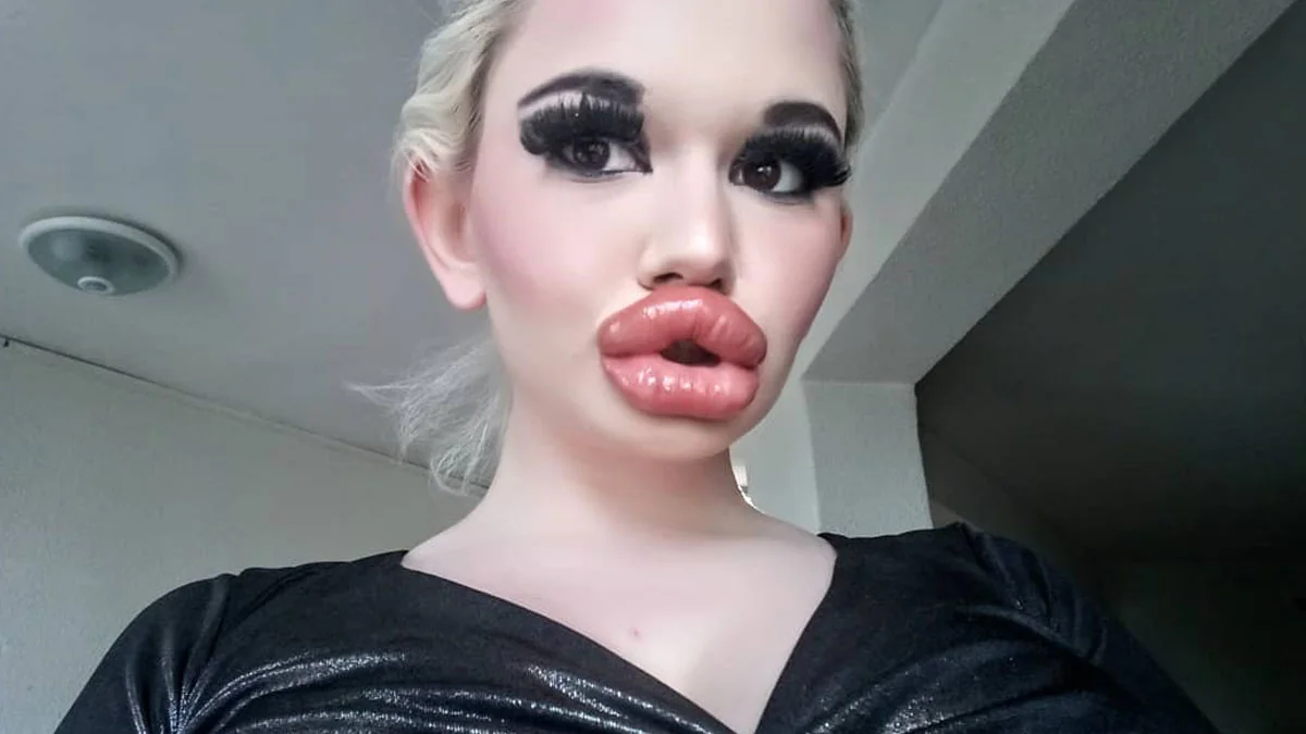Bulgarien: Frau, die die größten Lippen der Welt haben möchte, lässt sie sich zum 20. Mal aufspritzen
