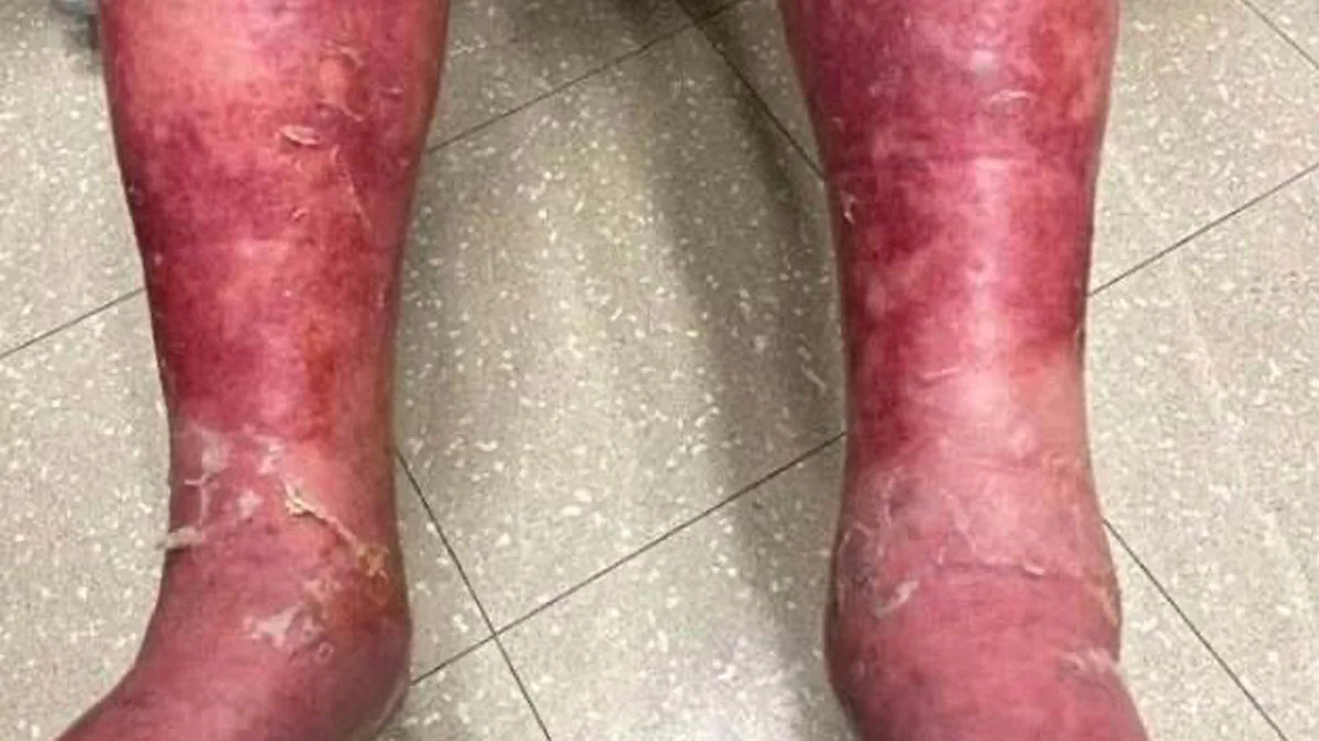 Genetische Veranlagung: Mann bekommt heftigen Ausschlag nach Impfung