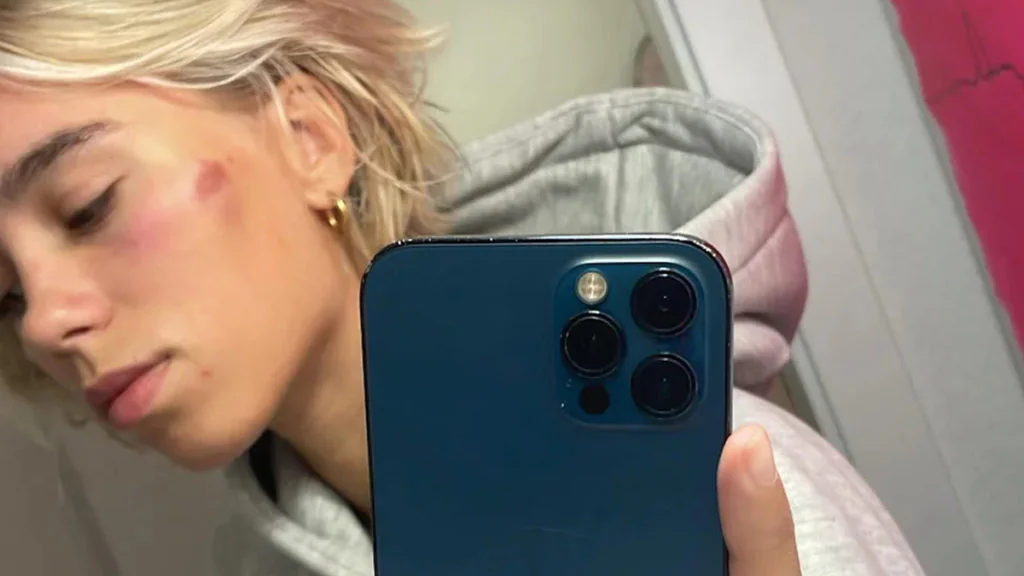 Influencerin Lena Mantler kassiert blaues Auge