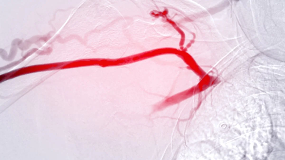 Verkalkte Arterien: Bild der Angioplastie, Ballonangioplastie und perkutanen transluminalen Angioplastie (PTA) .