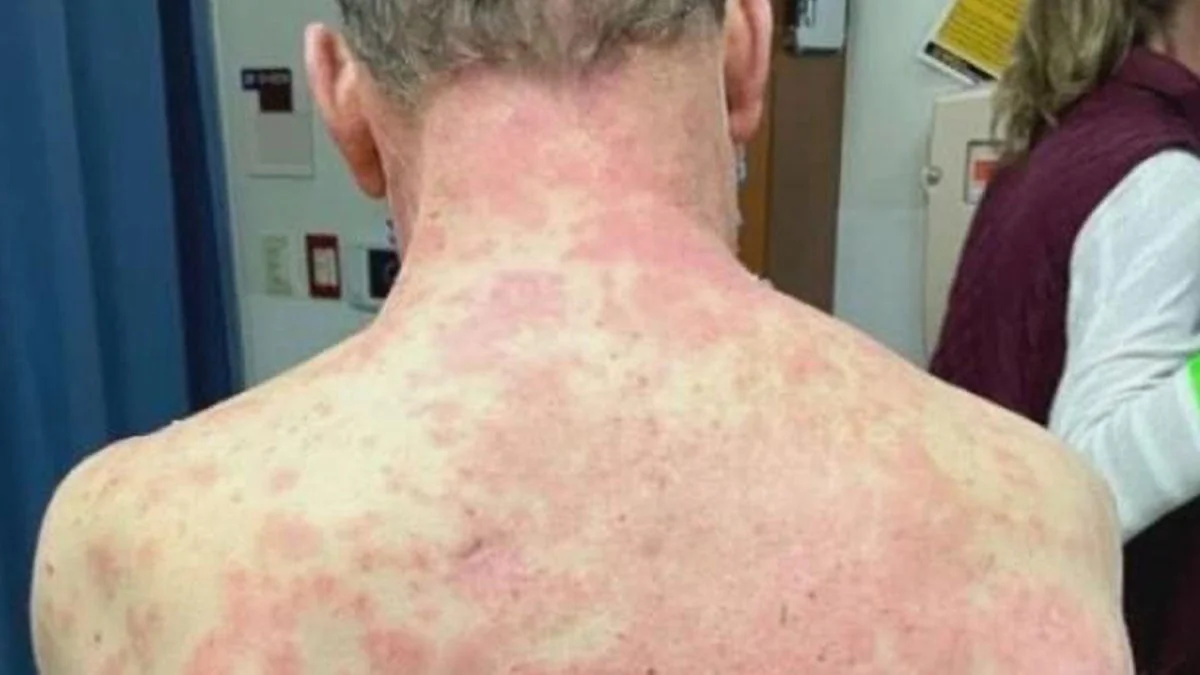 Genetische Veranlagung: Mann bekommt heftigen Ausschlag nach Impfung