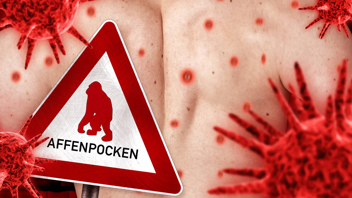 Notstand wegen Affenpocken ausgerufen: Das sind die Folgen