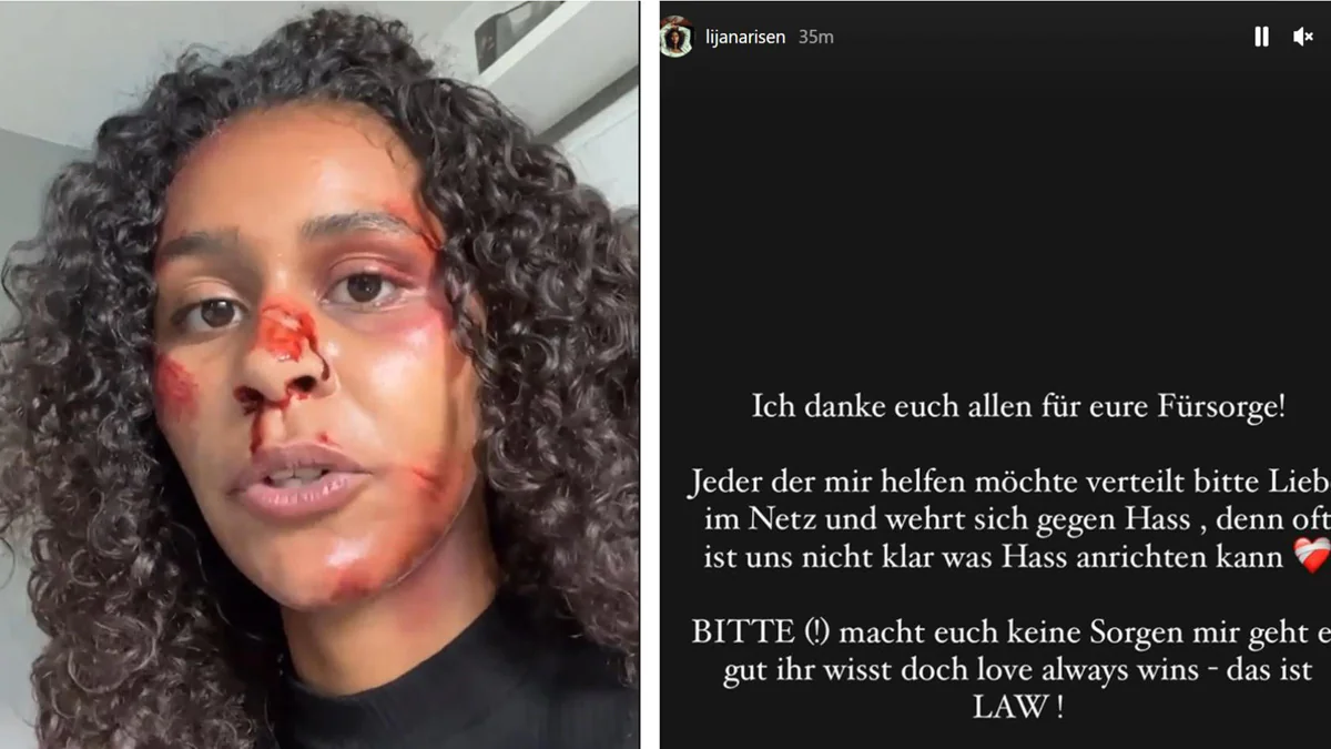 Voller Blut: GNTM-Lijana schockt Fans