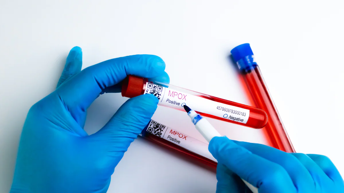 MPOX-Virus breitet sich aus - „Risiko für die ganze Welt“
