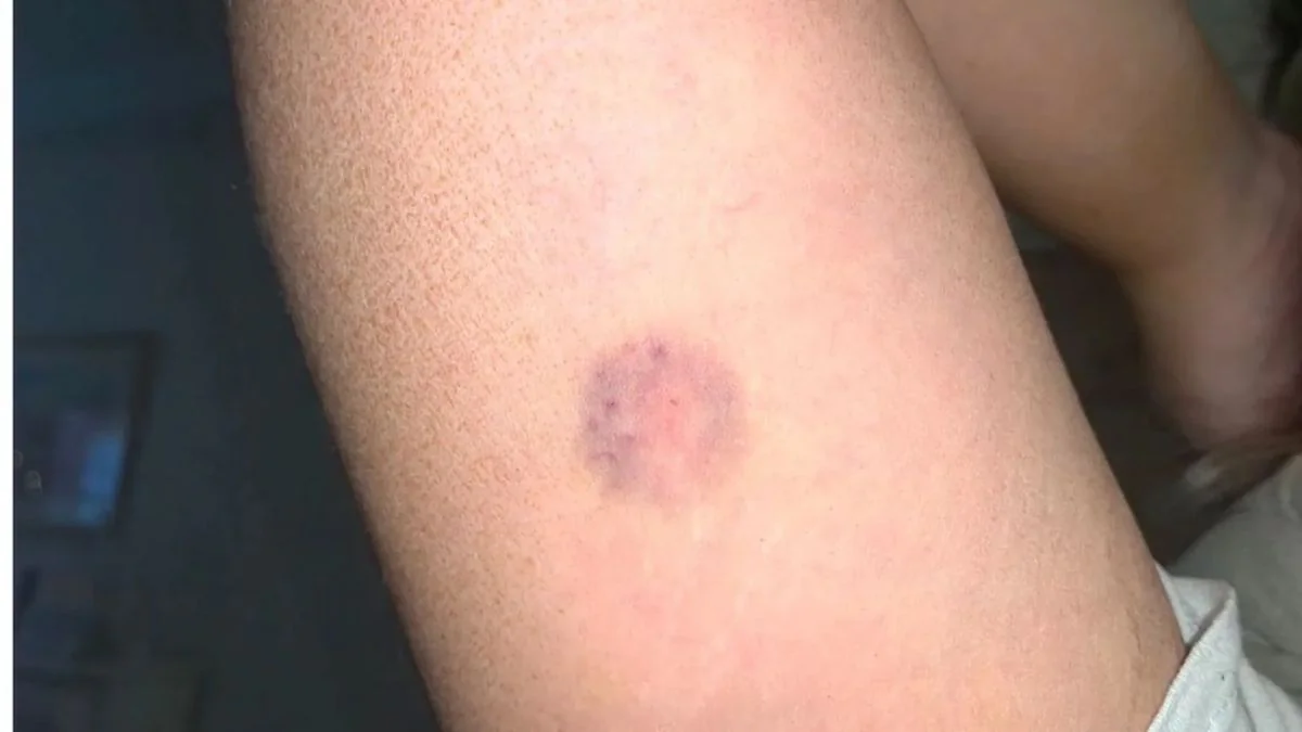Needle Spiking Einstichstelle am Arm