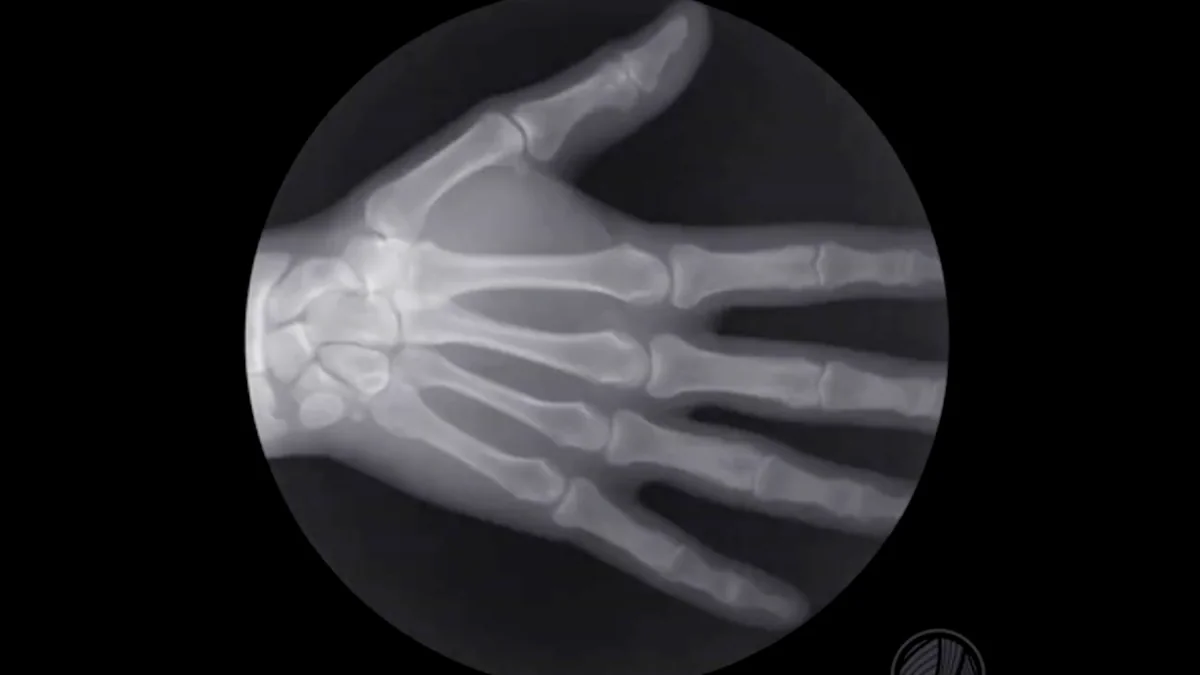 Fingerknacken: Röntgenbild ener Hand