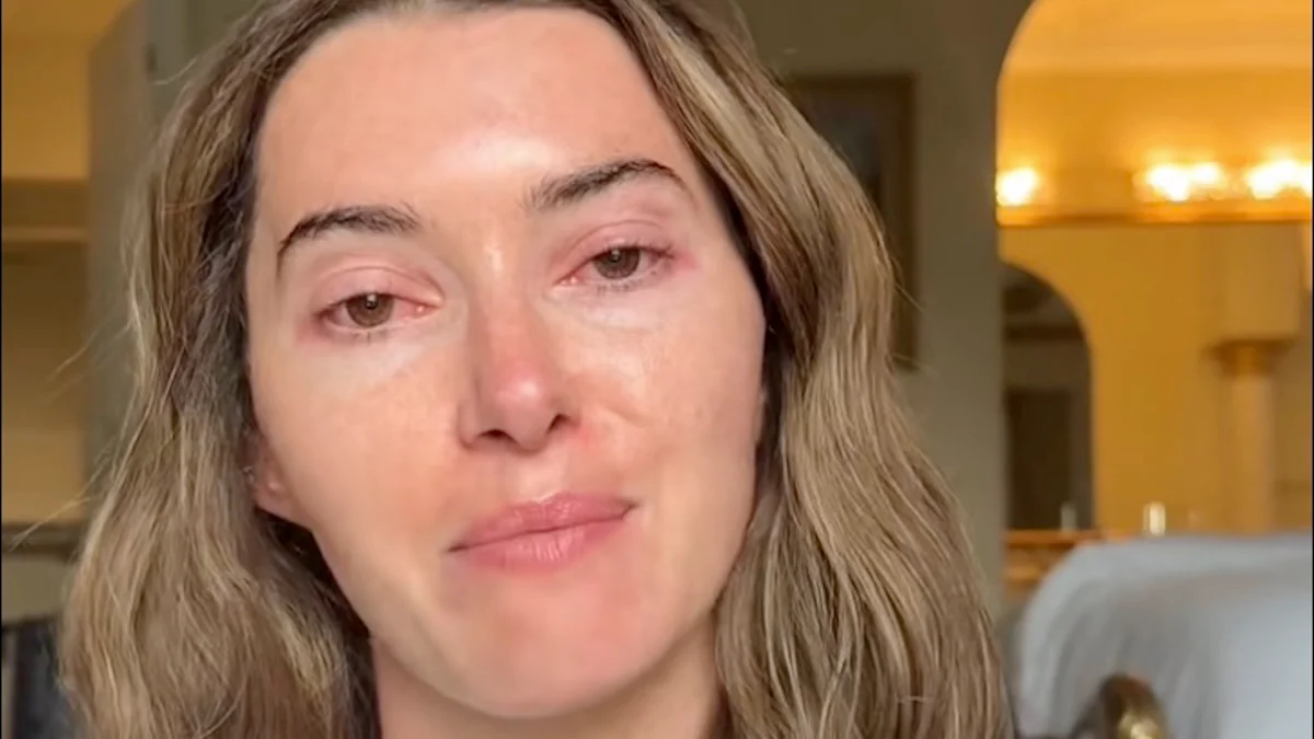 Influencerin Madeleine White Fedyk mit Bindehautentzündung